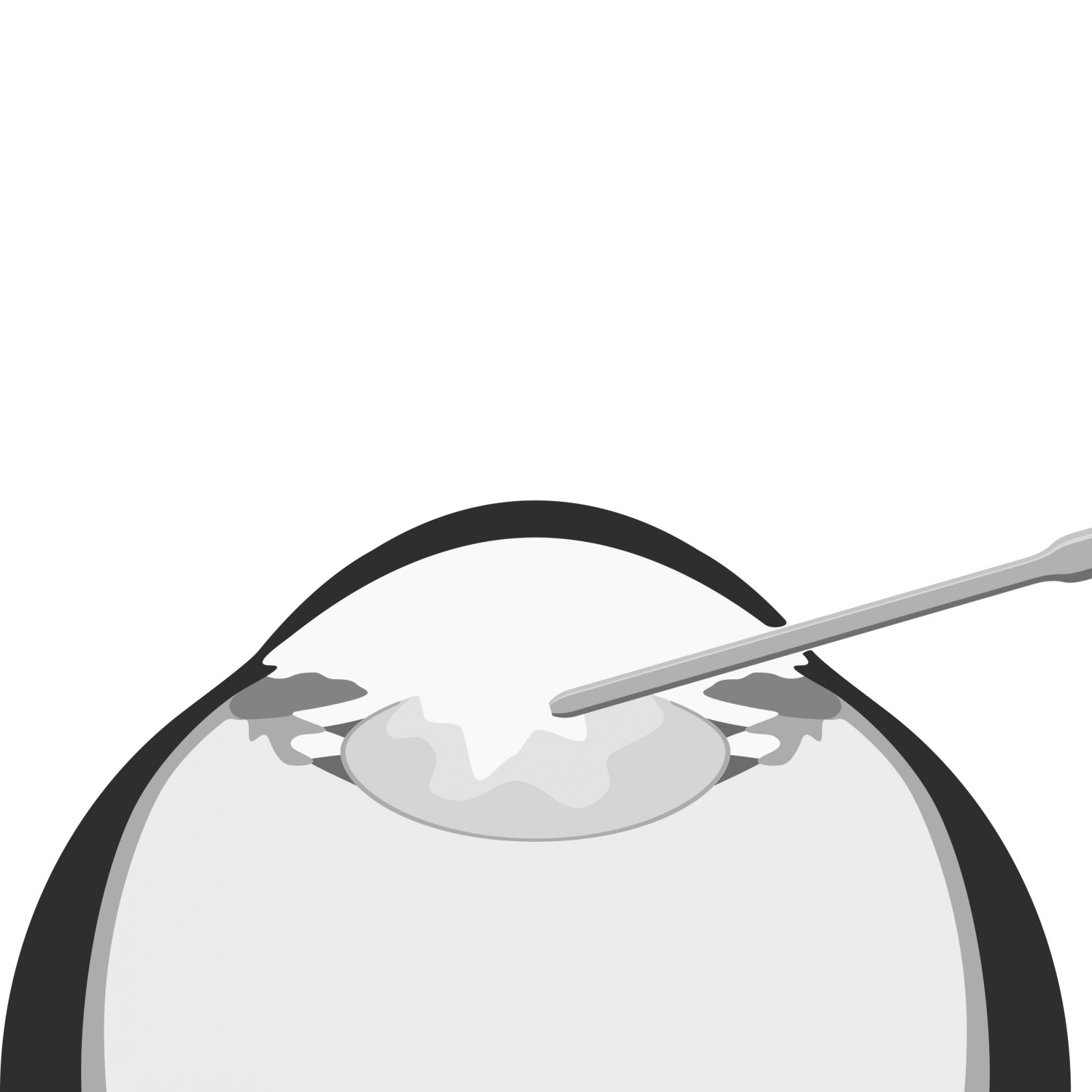 Grauer Star Behandlung in Neus - Augenarzt Dr. Claus Thimm